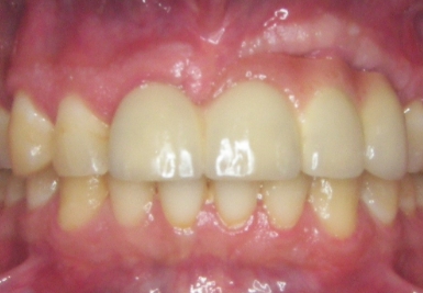 Close up of mouth with no gaps between teeth