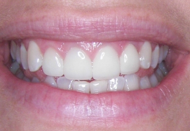 Smile with stainless teeth after cosmetic dentistry