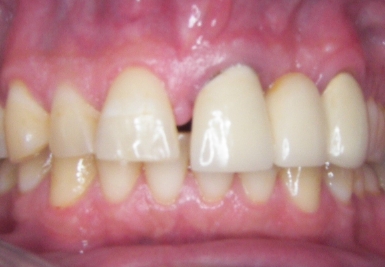 Close up of mouth with small gap between two front teeth