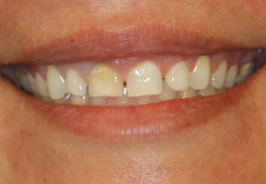 Smile with slightly gapped and discolored teeth