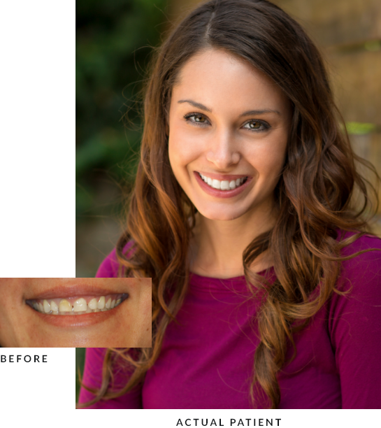Woman with flawless smile next to a close up of her flawed smile before dental treatment