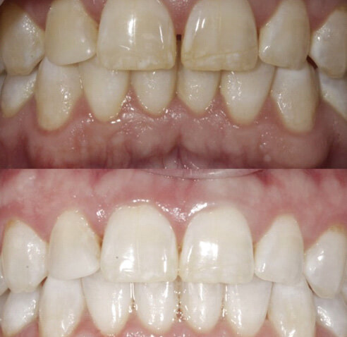 befor and after pictures of a smile after teeth whitening