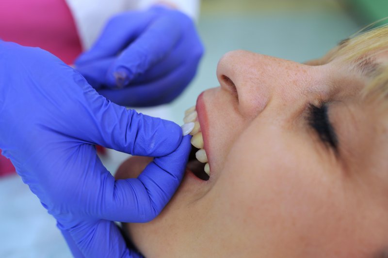 A dentist placing dental veneers on a woman’s teeth